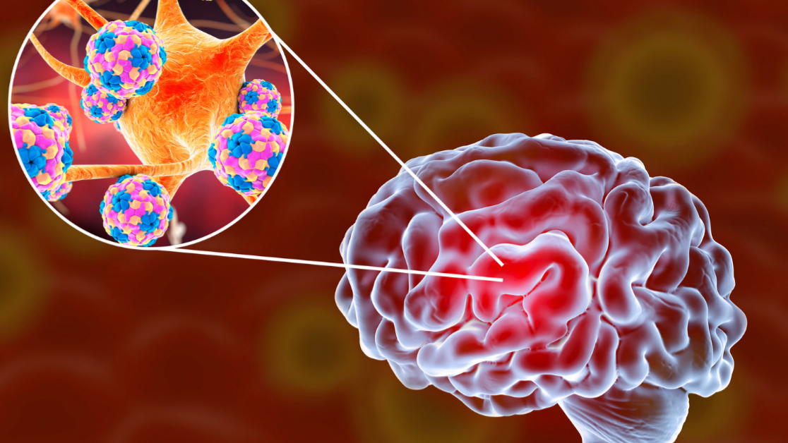 Neuro-Emergencies _ CNS Infections